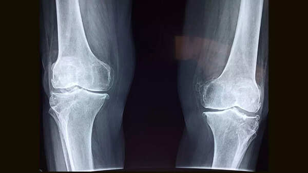broken-bones.jpg