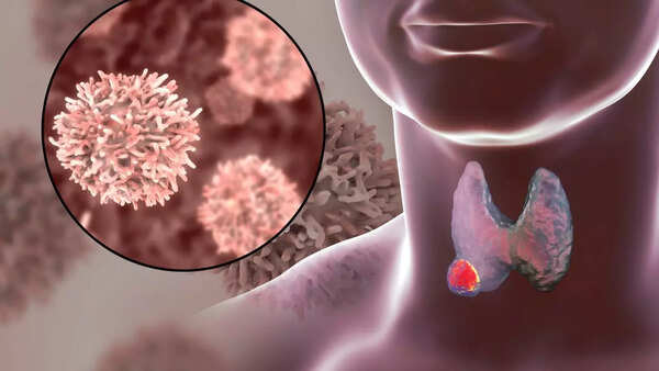 What is throat cancer