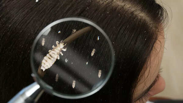 Head lice
