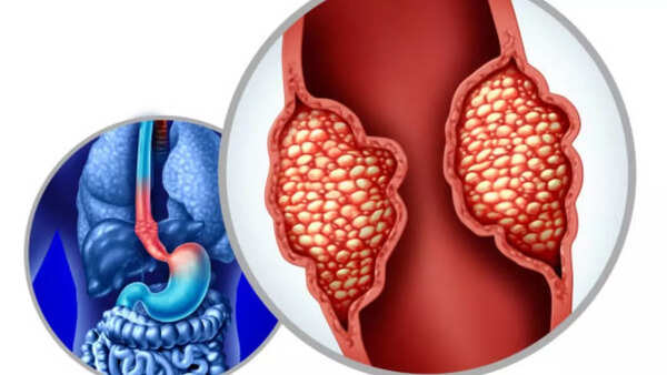 Esophageal Cancer Symptoms: Cancer alert: Man's first warning sign of esophageal  cancer was ignored by his doctor | - Times of India