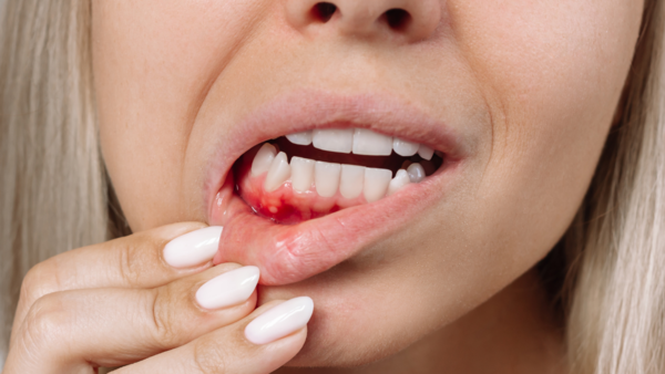 6 strange mouth symptoms that could signal a hidden deficiency - The Times  of India