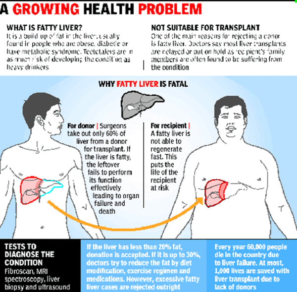 Over 50 liver donors have fatty organ India News Times of India