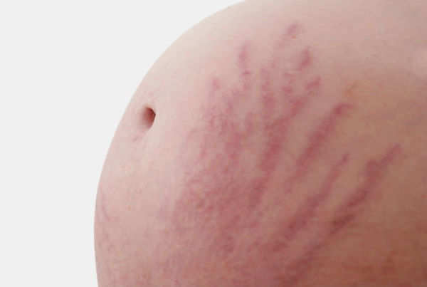 Stranden Begå underslæb Erobring The difference between red and white stretch marks - Times of India