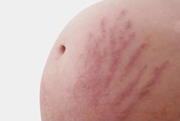 Stretch Marks That Hurt