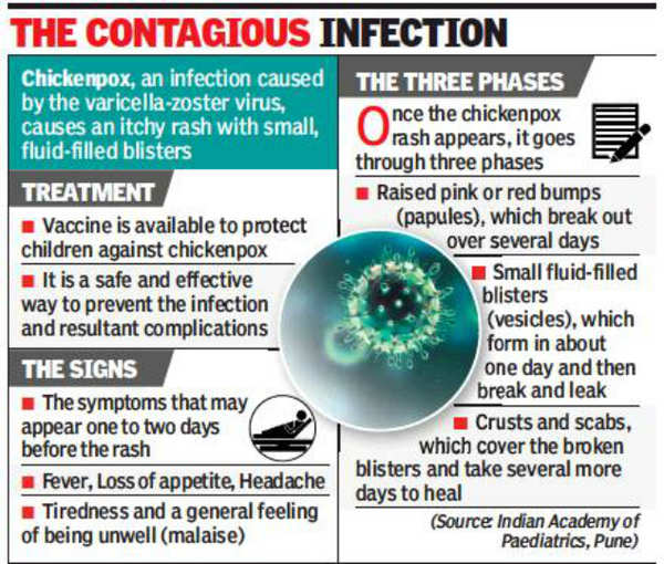 Pune Change in season spurs rise in chickenpox cases Pune News