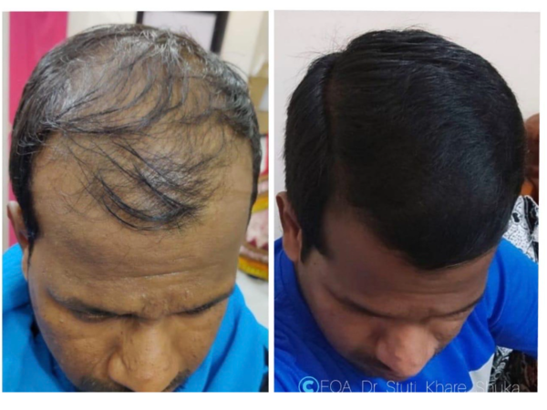 Hair Treatment Doctors in Varanasi - View Cost, Book Appointment, Consult  Online