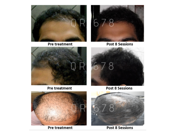 Hair Fall Treatment Hair Growth Advanced Treatment