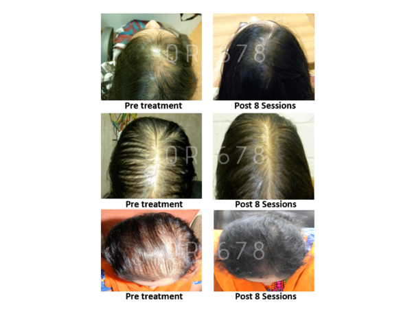 A Comprehensive Guide to Hair Loss Causes and Treatments