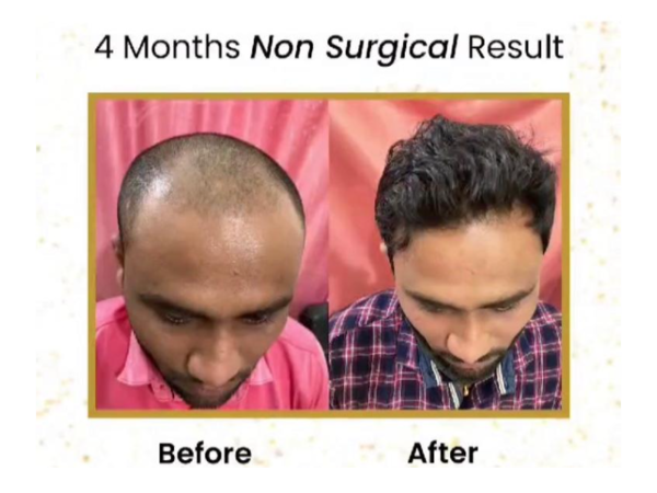 Best hair loss 2025 doctor in india