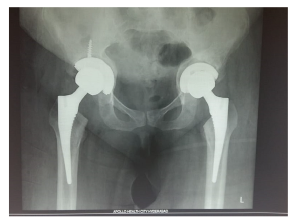 Evolving dynamics in total hip replacement patient care - Times of India