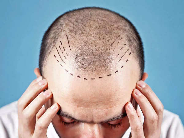 What to ask before going for a hair transplant: Do you really need one? Is  your technician qualified? - Times of India