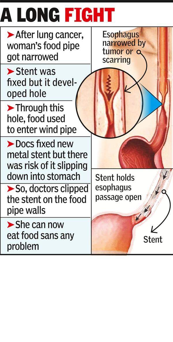 lung-cancer-weakens-food-pipe-complex-procedure-saves-woman-nagpur