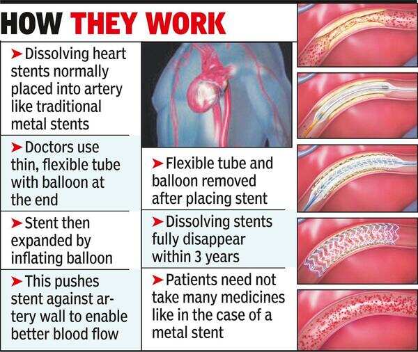 Use Of Dissolving Heart Stents Now Commonplace Times of India