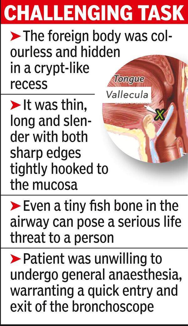 Anaesthesia Fish Bone In Throat Removed Without General Anaesthesia Times of India