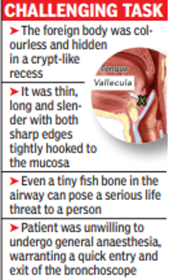 Anaesthesia Fish bone stuck in throat removed without general
