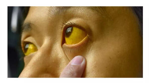 Yellowing of Skin and Eyes