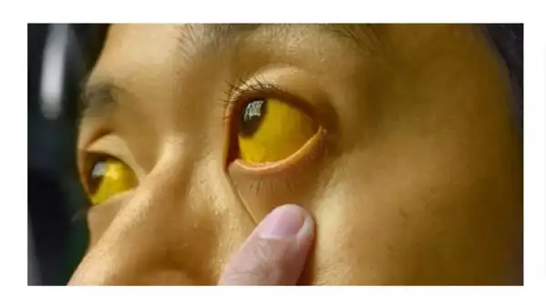 Jaundice