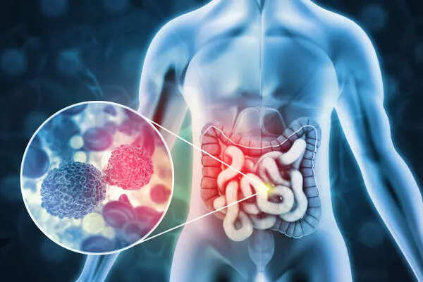 Bowel cancer: One of the earliest signs of colorectal (bowel) cancer includes a recent change in bowel habits