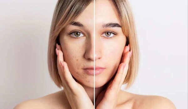Skincare solutions for pigmentation and uneven skin tone: One step you’re probably skipping