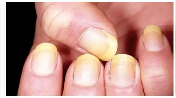 Yellow Nails