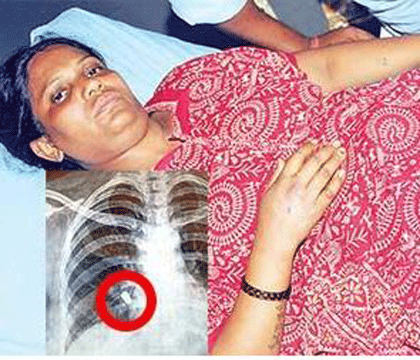 No heart attack, doctors dig out bullet from chest