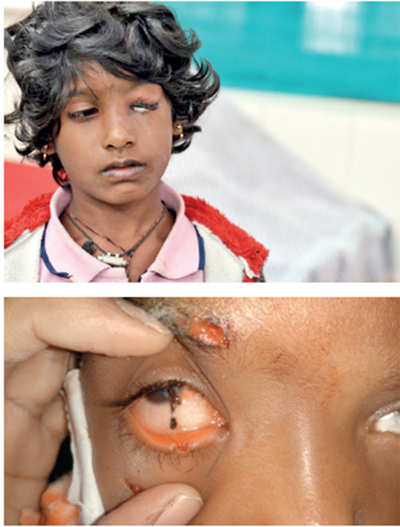 Eye injuries dull Deepavali sparkle