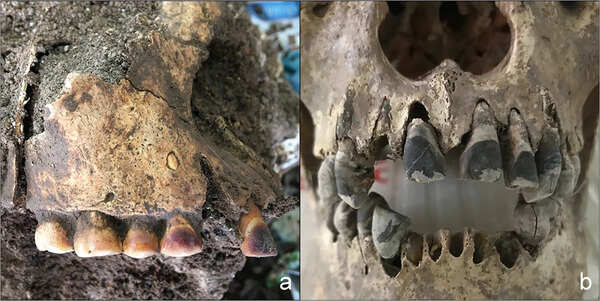 2,000 years ago, people in Vietnam used iron to permanently blacken their teeth
