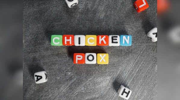 Chickenpox Symptoms: New variant of chickenpox-causing virus found in ...