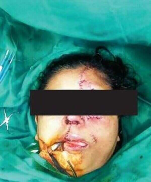 Woman gets life-saving facial surgery