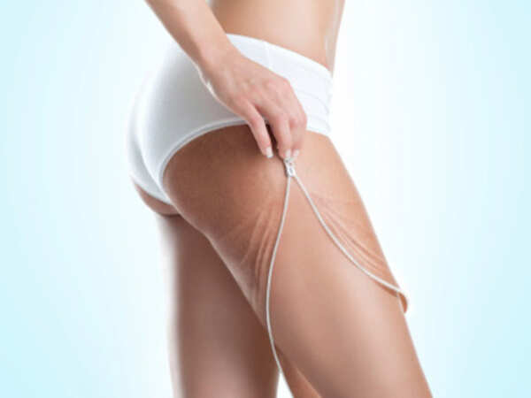Get rid of stretch marks with these simple steps