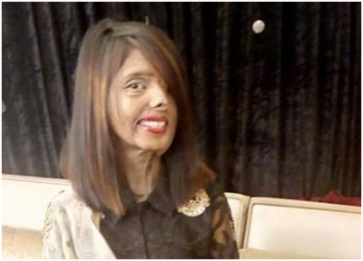Women’s Day Special: Acid attack survivor Shabbo Sheikh stays strong to fight discrimination