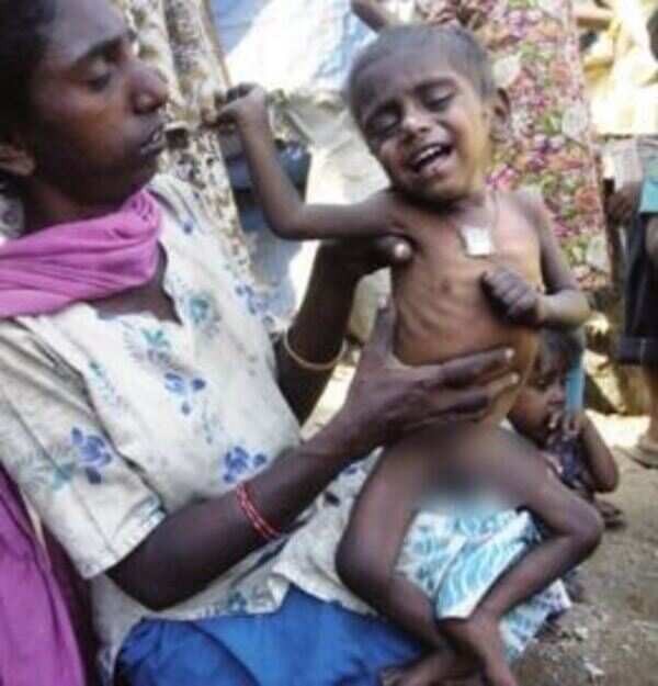 Kids severely malnourished but Karnataka govt looks the other way