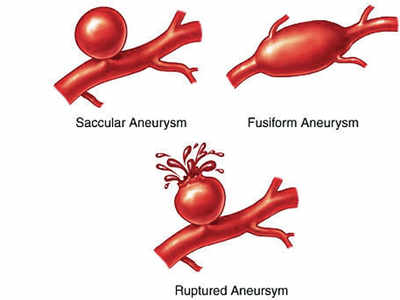 45-yr-old survives arterial aneurysm; doctors perform complex surgery