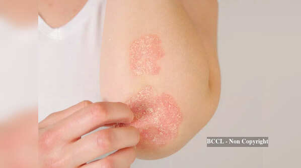 Skin Care: 5 reasons why your skin is peeling off