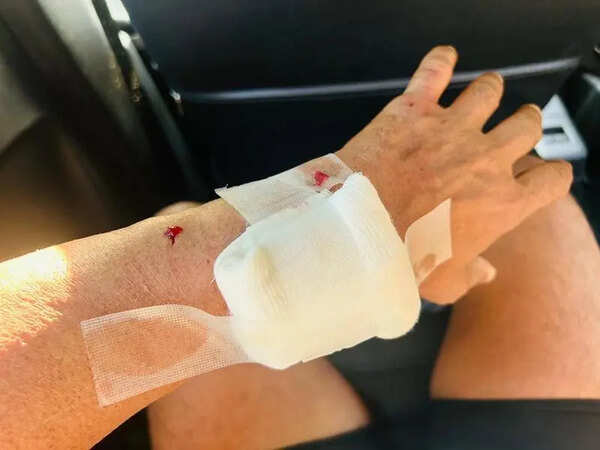 60-year-old marathon runner attacked by stray dog in Dumas