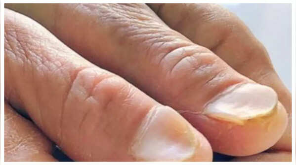 Spoon Nails