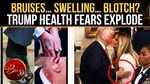 Donald Trump Health Buzz Explodes After Viral Hand Photos