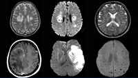 Study links increase in delirium, rare brain inflammation and stroke to Covid-19 