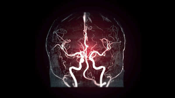 7 silent warning signs that may mean you need a Cerebral Angiography