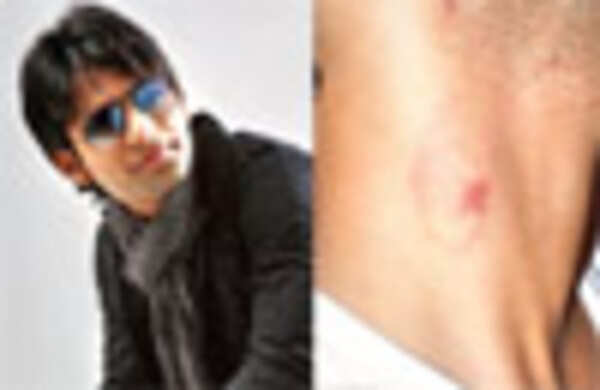 Rahul Vaidya's bitten by a mystery woman