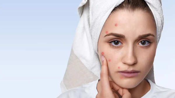 Acne Spot Correctors: Are They Worth The Hype?