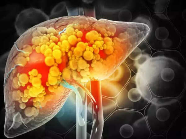 Diabetes emerges as a major driver of advanced liver disease in India