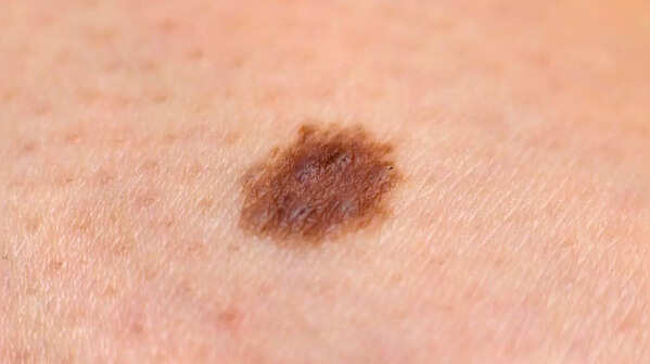 Notice pigment spreading beyond a mole