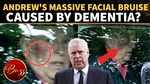 Andrew Windsor's Facial Injury Sparks Dementia Speculation After Insiders Sound Alarm 