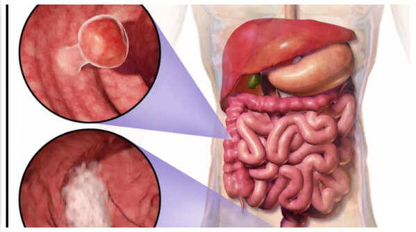 Blood in stool