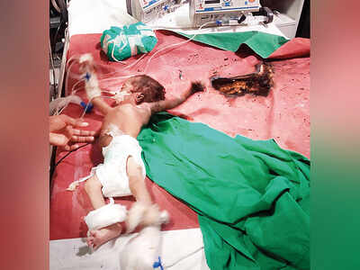 Four-month-old boy loses left arm and ear in KEM ICU fire