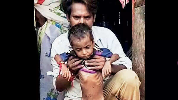 Over 130 children of Sahariya tribe malnourished in Baran district: Survey