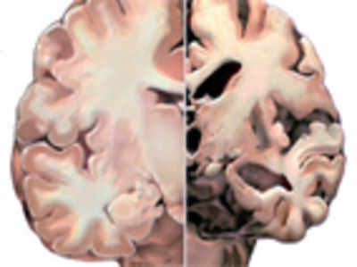 Aluminium, a likely villain in Alzheimer’s Disease