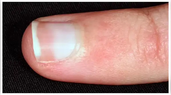 Pale or White Nails