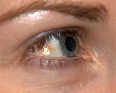 Woman has platinum jewellery implanted in EYE in $3,000 procedure